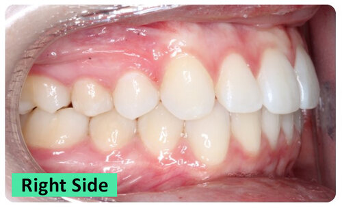 1-RightSide