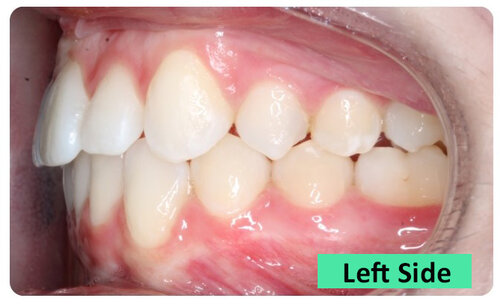 3-LeftSide