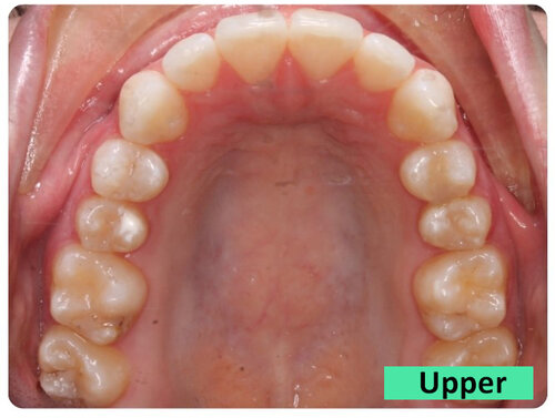 4-Upper