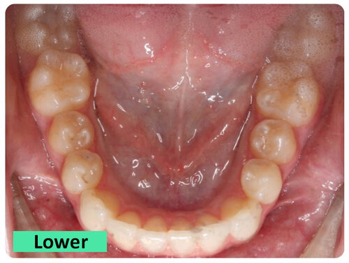 5-Lower
