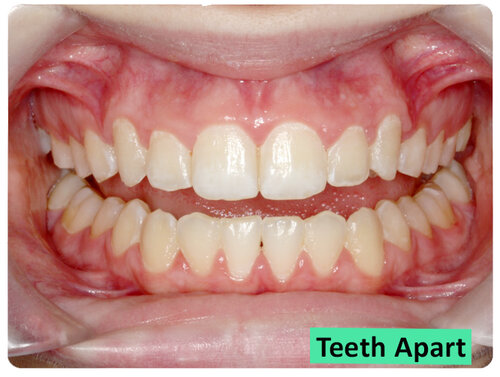 TeethApartMiddle-Centre
